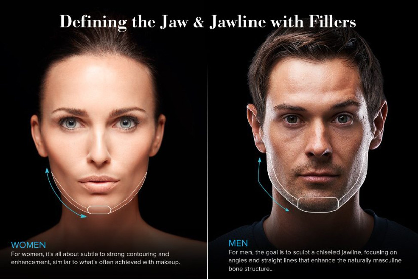 Filler Define Jawline for women and men