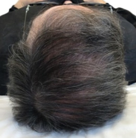 Hair Regrowth PRF After