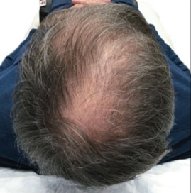 Hair Regrowth PRF Before