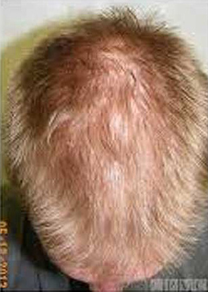 Hair Regrowth Treatment