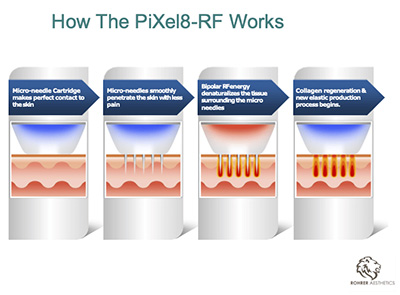 RF Microneedling with Pixel8 Santa Fe NM