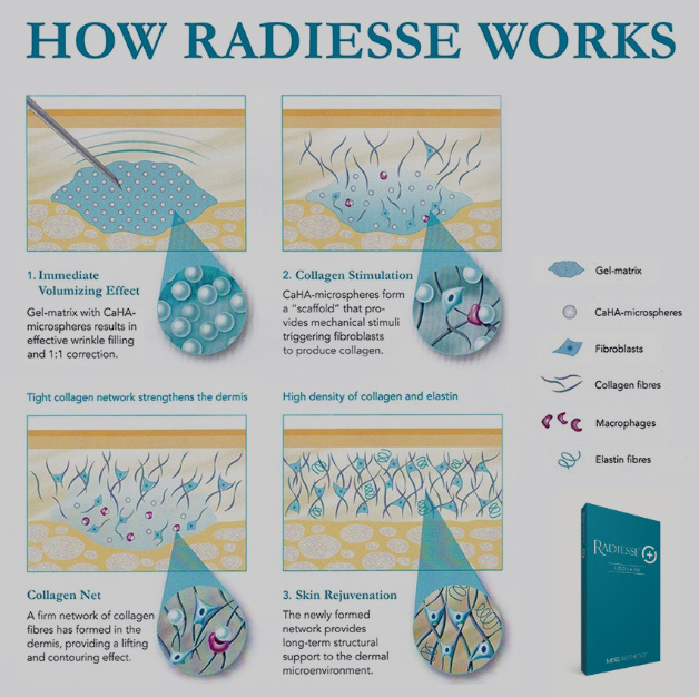 How Radiesse Works Diagram