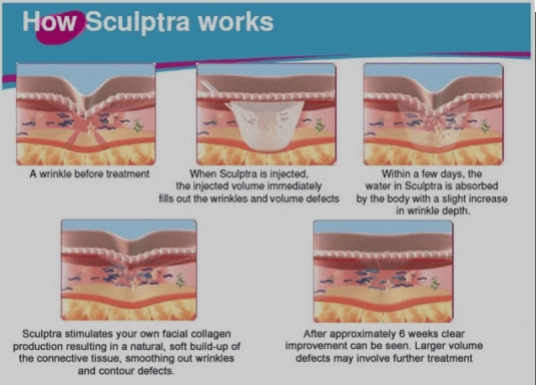 How Sculptra Works