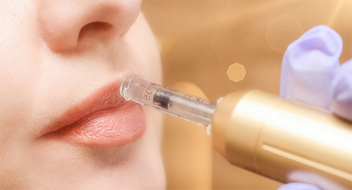 Dangers Of Hyaluron Pen Lip Fillers