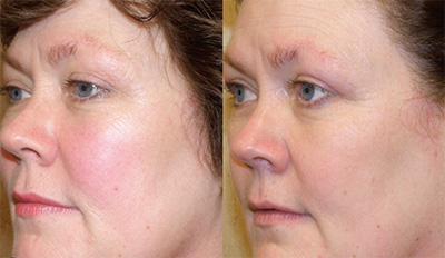 IPL Rosacea Treatment Santa Fe NM