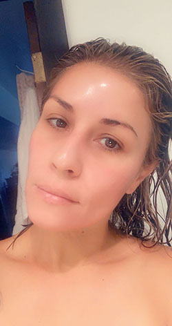 Jessner Peel Result
