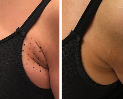 Kybella Bra Roll Treatment Santa Fe NM