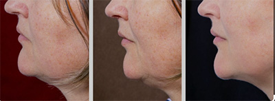 Kybella Double Chin Treatment Santa Fe NM