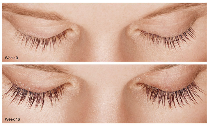 Latisse Eyelash Treatment