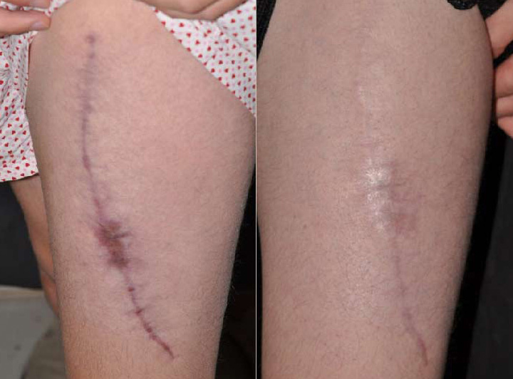 Scar Revision Treatment Santa Fe NM