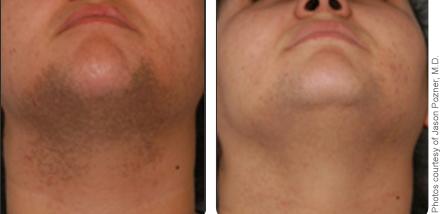 Male Chin Laser Hair Removal Santa Fe NM