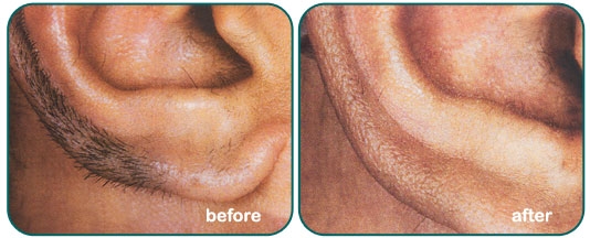 Male Ear Laser Hair Removal Santa Fe NM