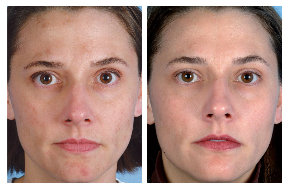 Microdermabrasion Results