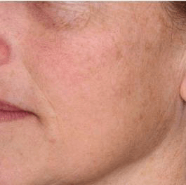 PRP Microneedling