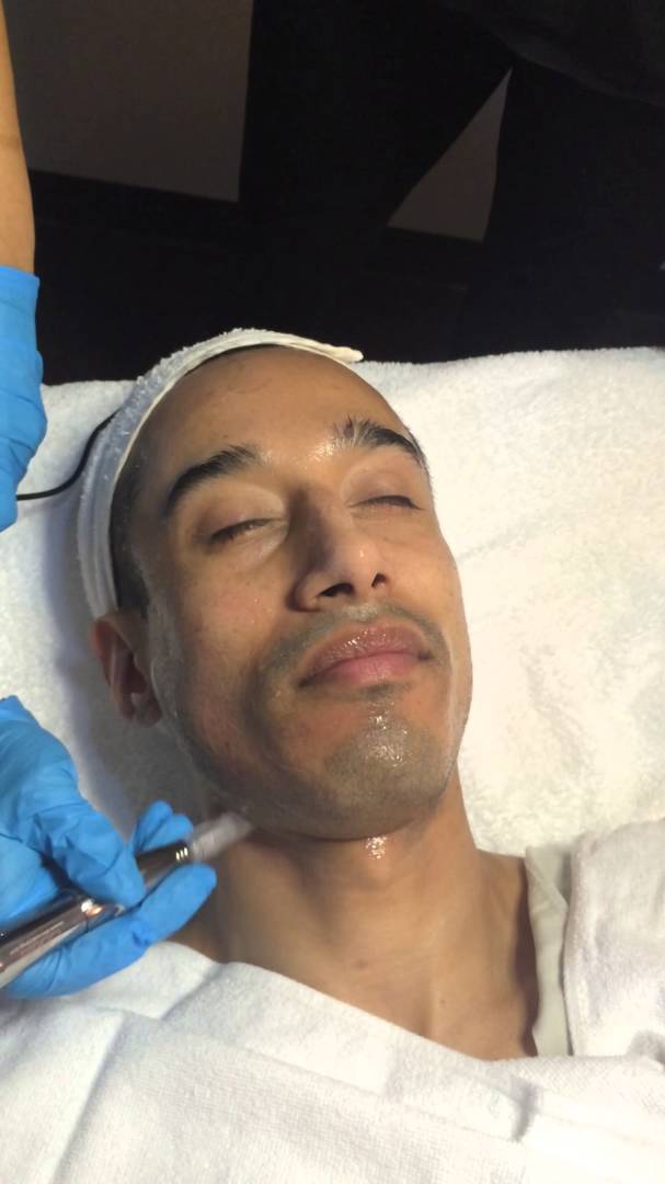 Microneedling for Men