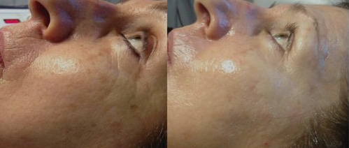 Microneedling with Retin A BnA
