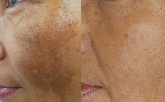 Microneedling with Retin A