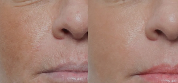 Microneedling with Topical Exosomes