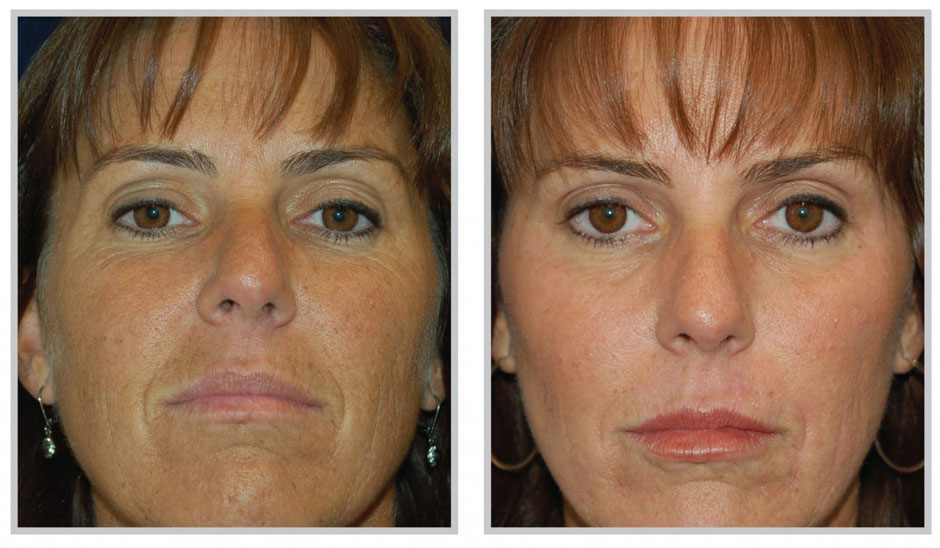 MicroPeel with Dermaplaning Santa Fe NM