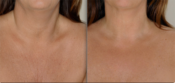 PDO Thread Decolletage Results