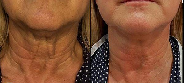 PDO Thread Neck Lift Results