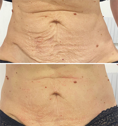 RF Microneedling Abdomen Treatment Santa Fe NM