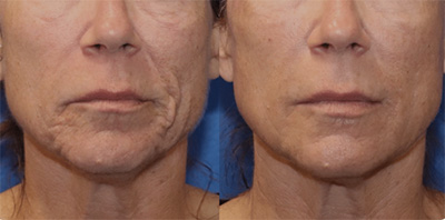 RF Microneedling Female Lower Face Treatment Santa Fe NM