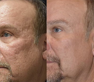 RF Microneedling Male Face Treatment Santa Fe NM