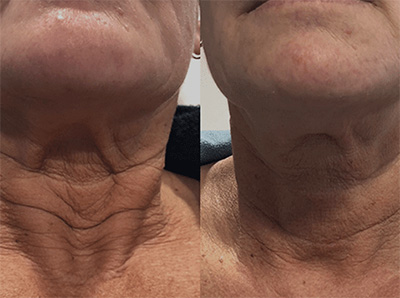 RF Microneedling Neck Treatment Santa Fe NM