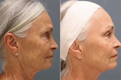 RF Microneedling Older Female Before and After Santa Fe NM