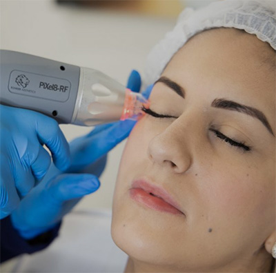 RF Microneedling Expert Santa Fe NM