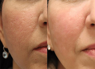 RF Microneedling Scar Treatment Santa Fe NM