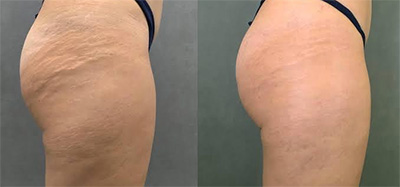 RF Microneedling Stretch Mark Treatment Santa Fe NM