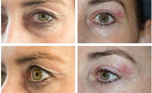 Skin Tightening Santa Fe NM