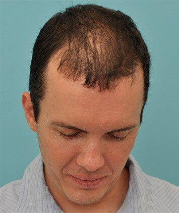 PRF Hair Regrowth