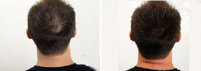 PRP Hair Growth Santa Fe NM