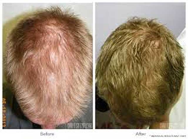 PRP Hair Restoration Santa Fe NM