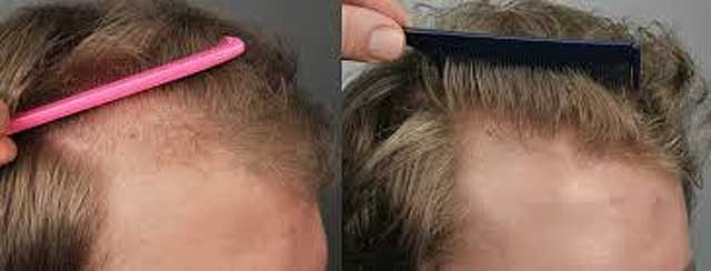 PRP Hair Treatment Santa Fe NM