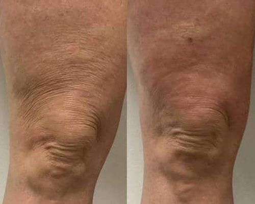 Radiesse Hyperdilute Female Above Knees BnA