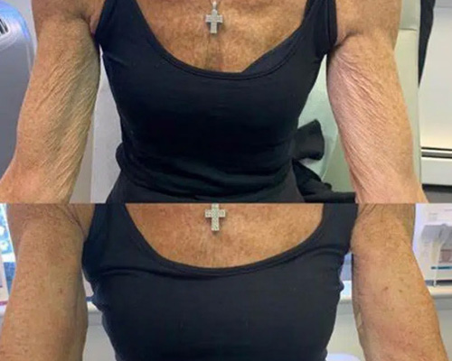 Radiesse Hyperdilute Female Arms and Chest BnA