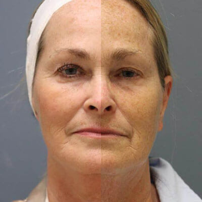 RF Microneedling