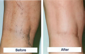 Sclerotherapy Spider Vein Treatment Before and After