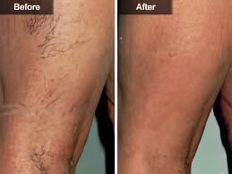 Sclerotherapy Varicose Vein Treatment Before and After