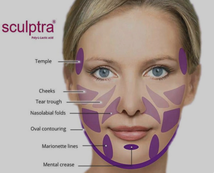 Sculptra Treatment area diagram