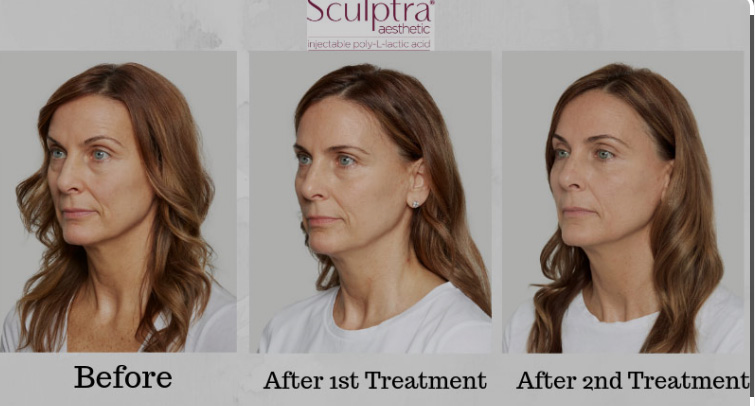 Sculptra Before and After the 1st and 2nd Treatment