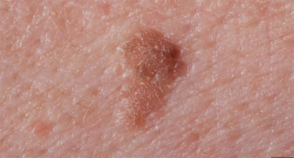 Seborrheic Keratosis