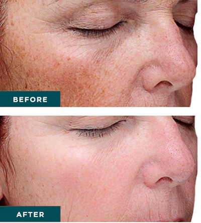 VI Peel Precision Plus | Chemical Peels in Santa Fe, NM