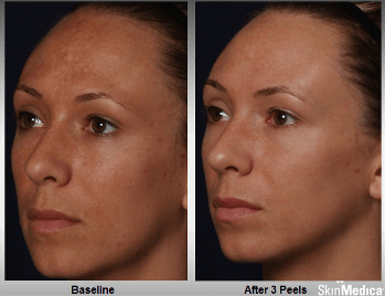 Vitalize Peel Santa Fe NM