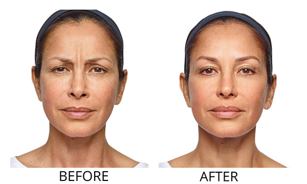 Xeomin Results