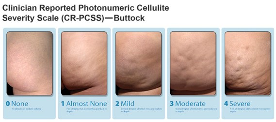 Cellulite Severity Scale on Buttock
